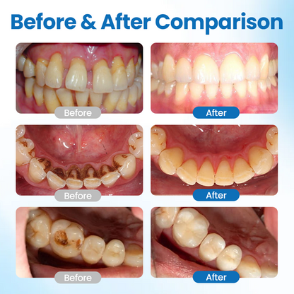 Suero protector dental LBMLBM™ NanoHAP 